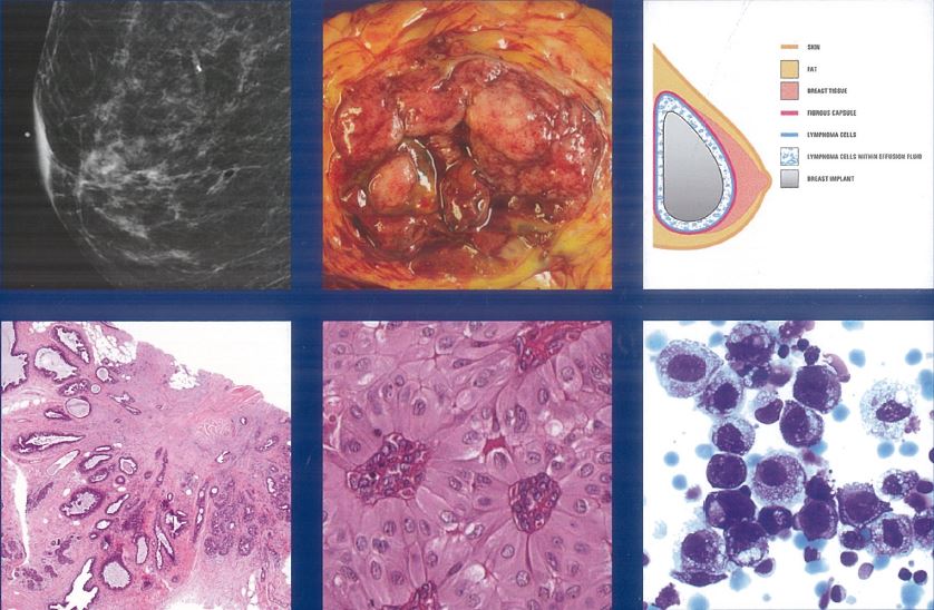 2019 WHO 5th 乳腺肿瘤分类