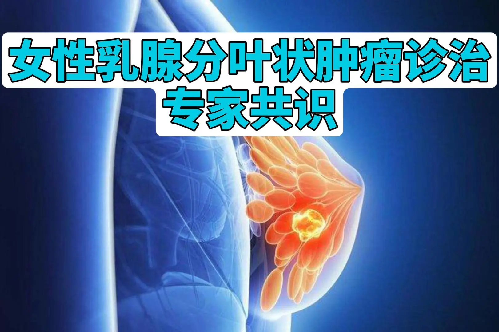 中国女性乳腺分叶状肿瘤诊治专家共识