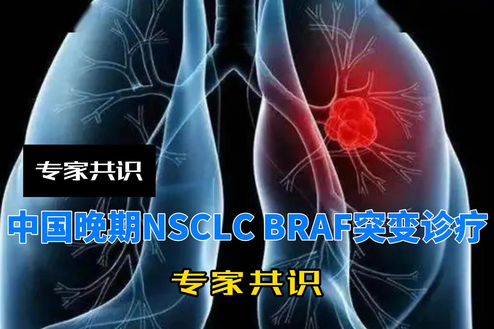 中国晚期NSCLC BRAF突变诊疗专家共识(2023)