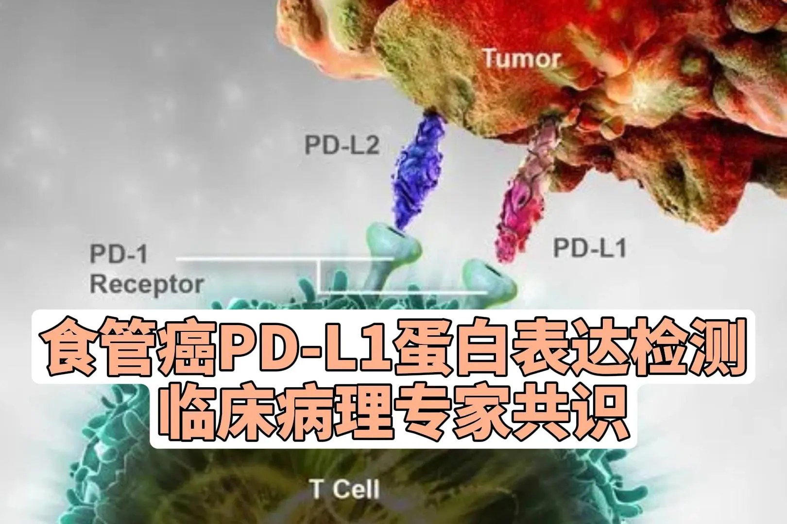 中国食管癌PD-L1蛋白表达检测临床病理专家共识