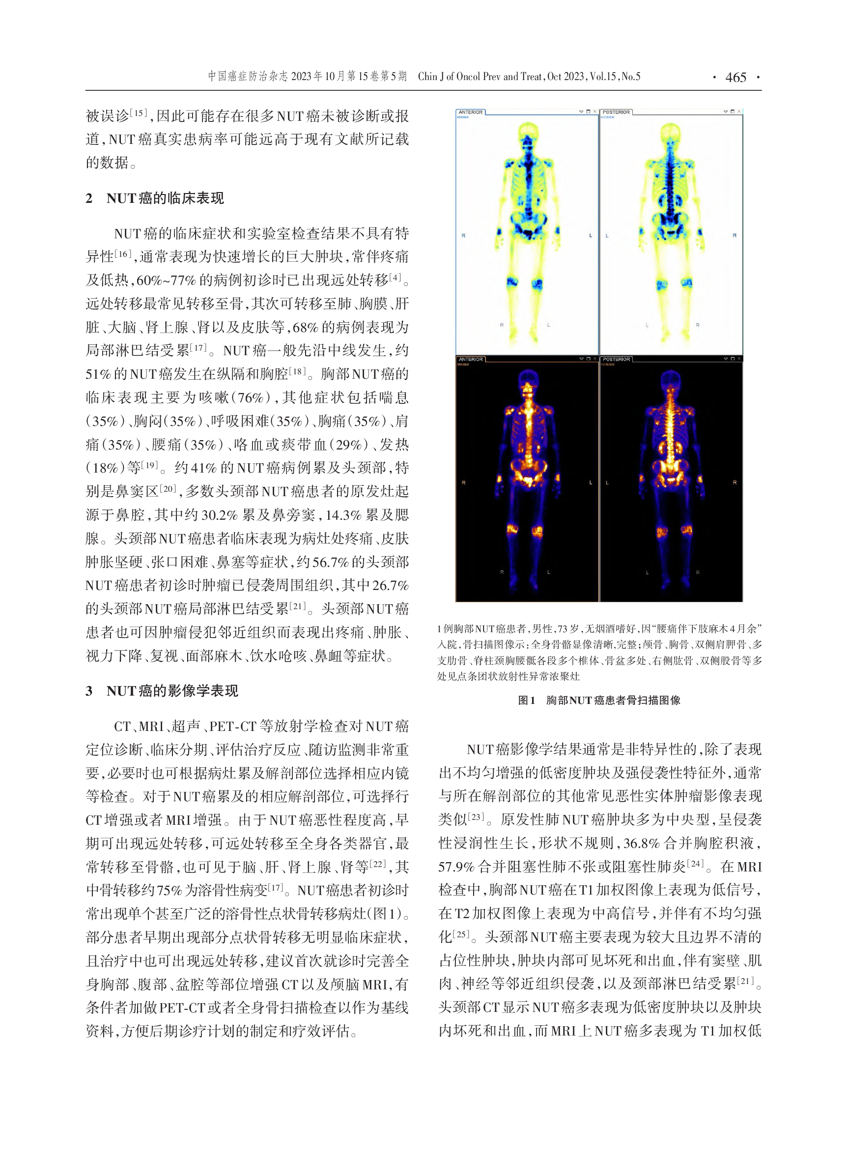 中线(NUT)癌诊断与治疗专家共识（2023版）-003.png