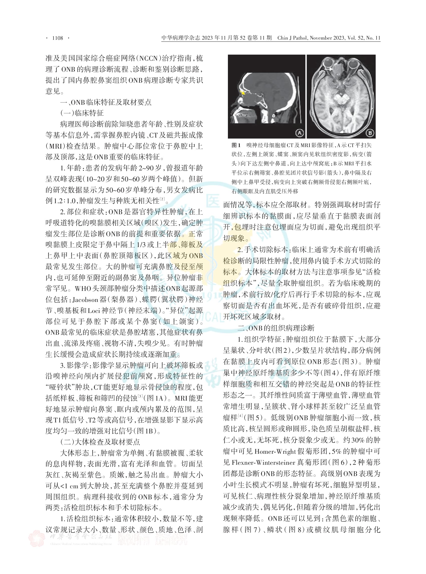 嗅神经母细胞瘤病理诊断中国专家共识（2023版）-002.jpg