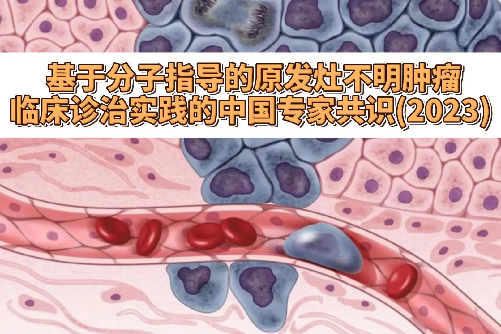  基于分子指导的原发灶不明肿瘤临床诊治实践的中国专家共识(2023)