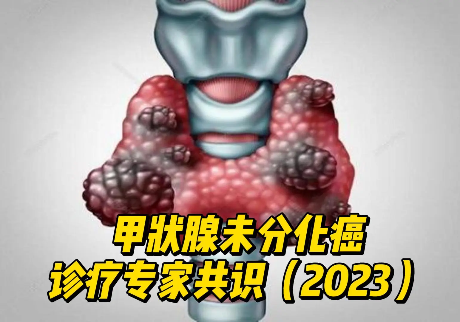  甲状腺未分化癌诊疗专家共识(2023)