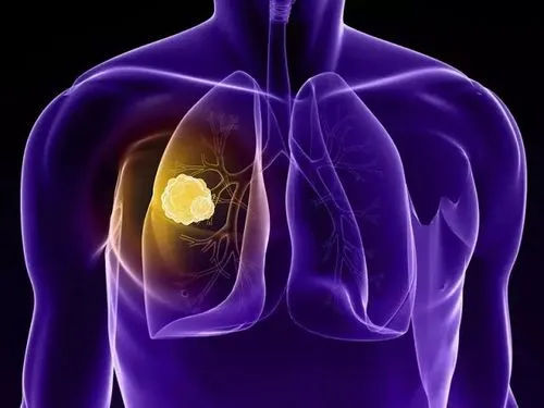 非小细胞肺癌MET免疫组化检测和判读标准(2023)