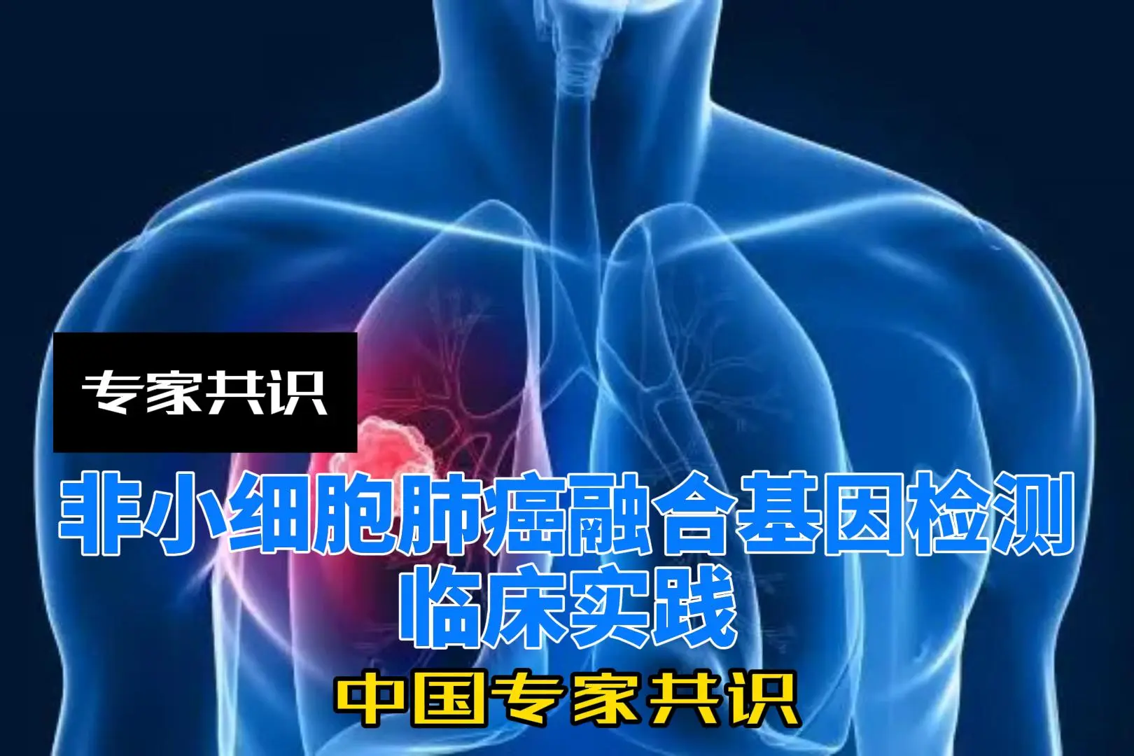 NSCLC融合基因检测临床实践中国专家共识(2023)