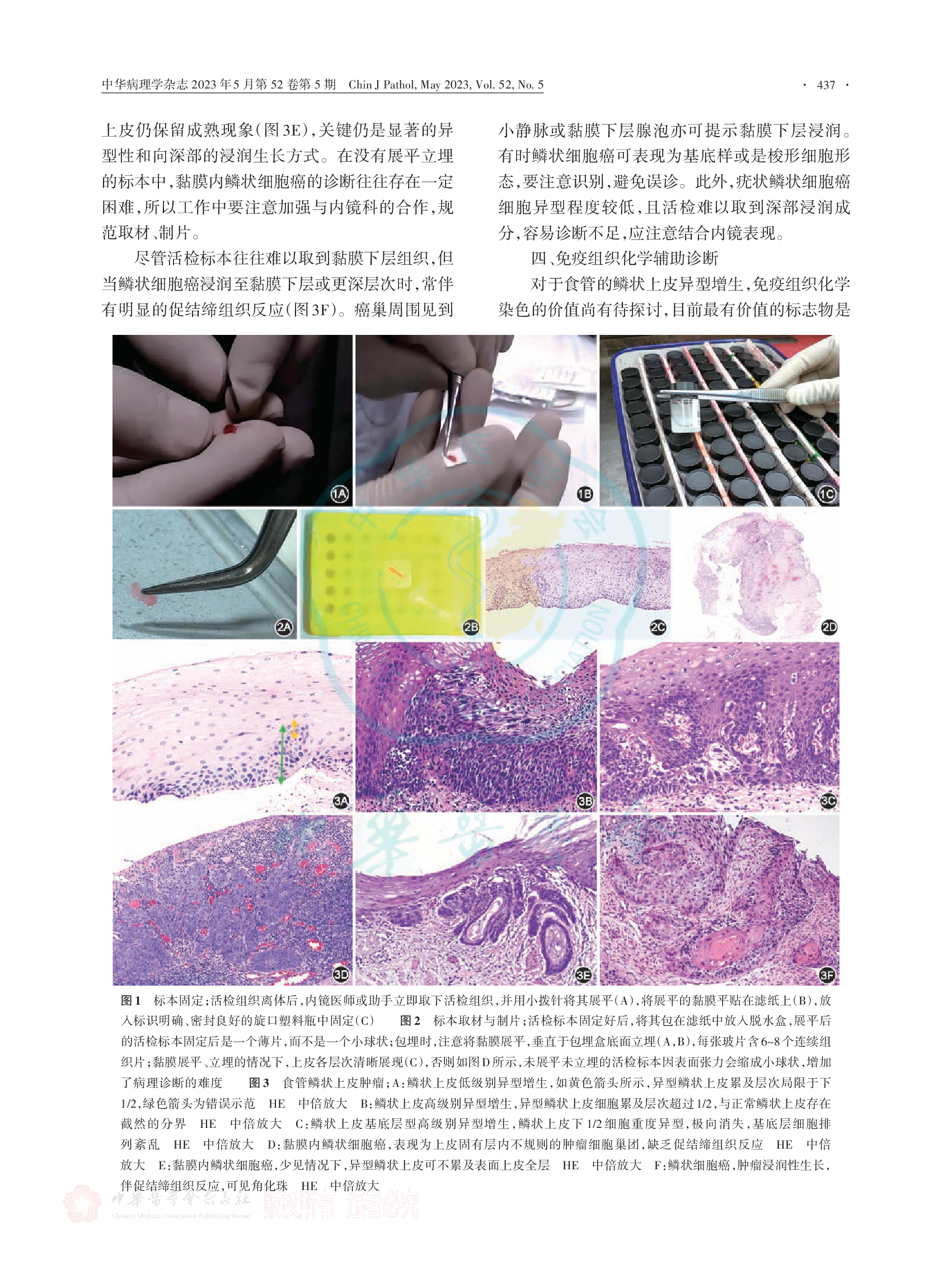 食管活检标本鳞状上皮肿瘤病理诊断专家共识（2023）-003.png
