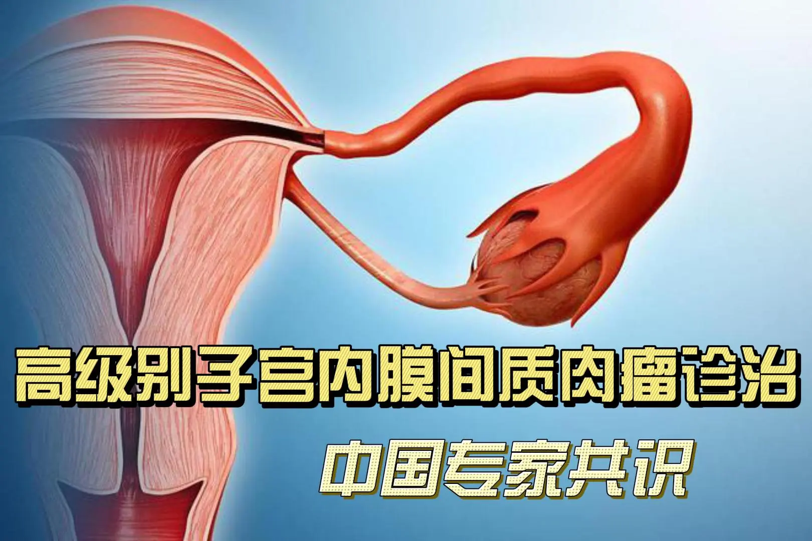 高级别子宫内膜间质肉瘤诊治中国专家共识(2023)