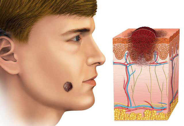  中国黑色素瘤规范化病理诊断专家共识(2017)